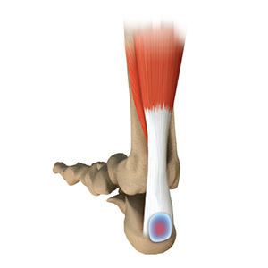 Achilles Tendon Bursitis sp