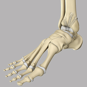 Ankle Arthrodesis sp