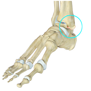 Ankle Impingement sp