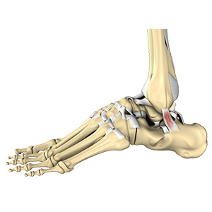 Ankle Sprain sp