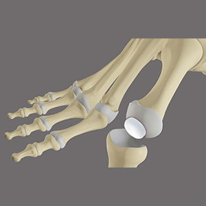 Big Toe Motion Preservation Surgery sp