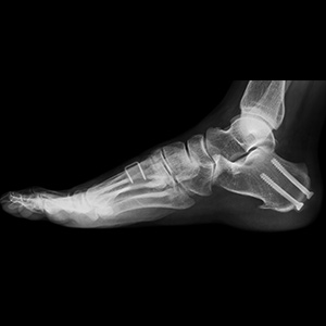 Cavus Foot Reconstruction sp