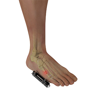 External Fixation for Foot and Ankle Trauma sp