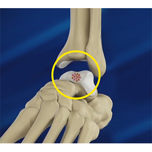Foot and Ankle Cartilage Repair sp