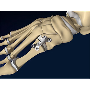 Foot & Ankle Deformity Correction sp