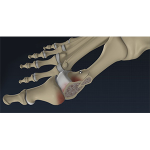 Foot and Ankle Osteotomy sp