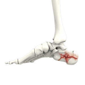 Foot Fracture sp