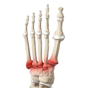 Midfoot Arthritis sp