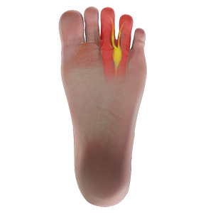 Morton's Neuroma sp