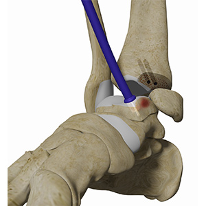 Osteochondral Allograft Transplantation System (OATS) of the Ankle sp