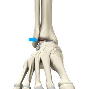 Osteochondral Injuries of the Ankle sp