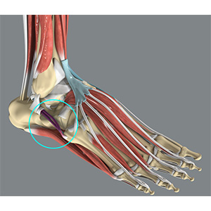 Peroneal Tendonitis sp