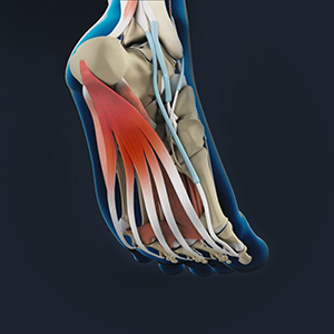Plantar Fascia Release sp