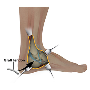 Posterior Tibialis Tendon Repair sp
