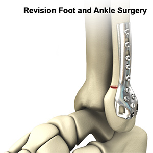 Revision Foot and Ankle Surgery sp