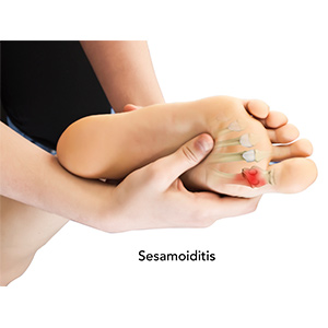Sesamoiditis sp