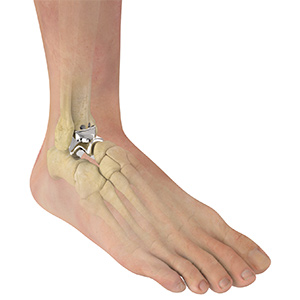 Total Talus Replacement sp