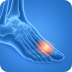 Bunions and Hammertoes Picture