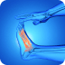 Charcot Foot and Ankle Picture