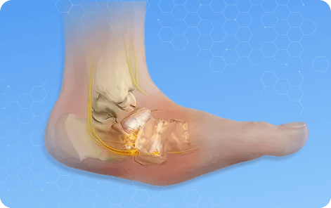 Charcot Reconstruction Picture