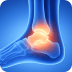 Foot and Ankle Fractures Picture