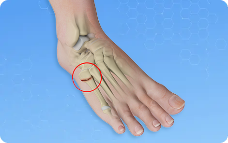 Jones Fracture Treatment Picture
