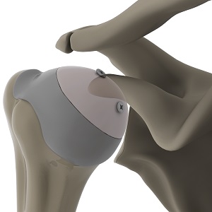 Humeral Head Reconstruction with Osteochondral Allograft Transplantation