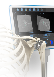 Computer Navigation For Shoulder
