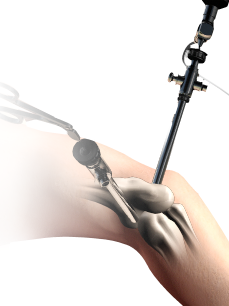 Elbow Arthoscopy Img