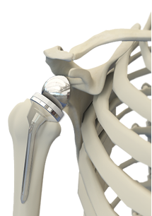 Reverse Shoulder Replacemet Img