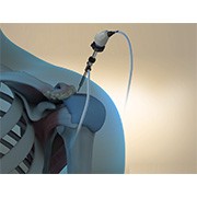 Arthroscopic Acromioplasty