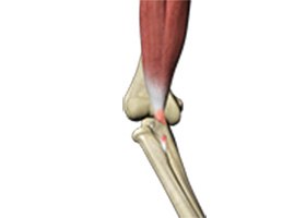 Biceps Tendon Repair