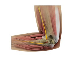 Cubital Tunnel Release (Medial Epicondylectomy)