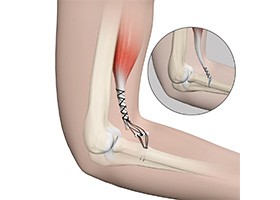 Distal Biceps Repair