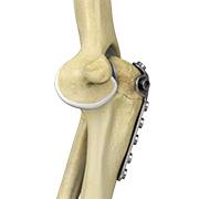 Elbow Fracture Reconstruction
