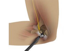 Endoscopic Cubital Tunnel Release