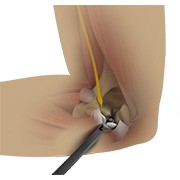 Endoscopic Cubital Tunnel Release