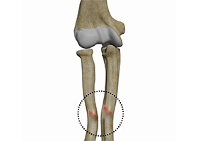 Malunion Surgery (Elbow)