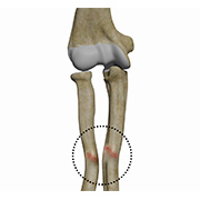 Malunion Surgery (Elbow)