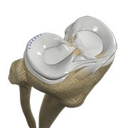 Meniscal Repair Surgery