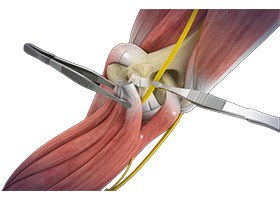 Open Cubital Tunnel Repair