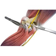 Open Cubital Tunnel Repair