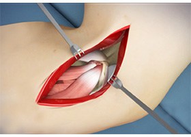Open Elbow Surgery