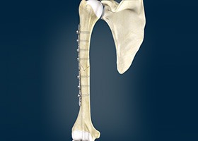ORIF of the Humerus Fractures