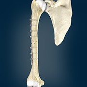 ORIF of the Humerus Fractures