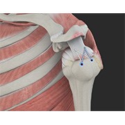 Rotator Cuff Repair