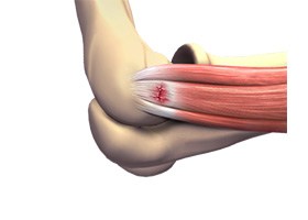 Tennis Elbow Surgery