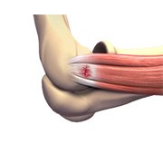 Tennis Elbow Surgery