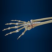 Total Wrist Arthrodesis