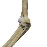 Ulnar Collateral Ligament (UCL) Repair with Internal Brace